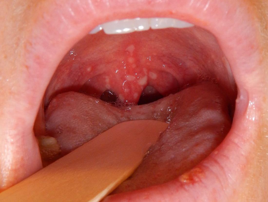 Despre herpangina